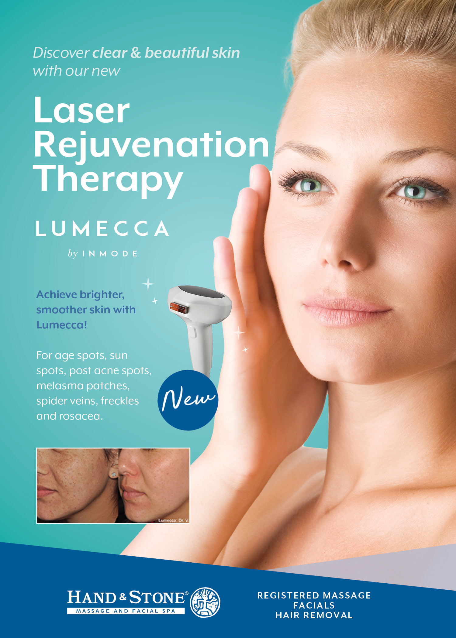 Lumecca Laser Rejuvenation Therapy